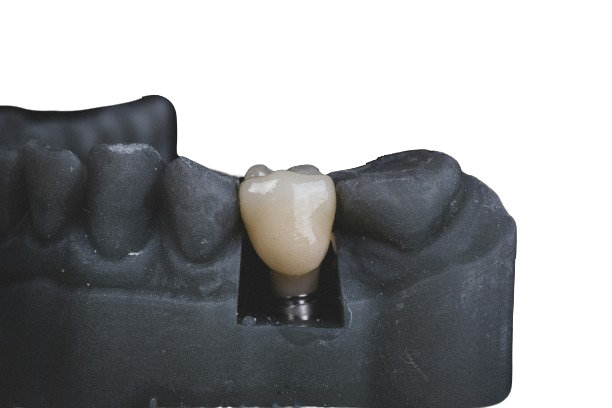 Ортопедичне лікування зубів